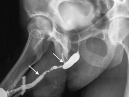 Erectile Dysfunction in Patients with Urethral Stricture After Endoscopic Urologic Surgery