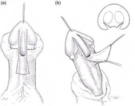 Glansplasty Success in Hypospadias Repair