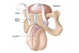 Male Slings for Post Prostatectomy Incontinence
