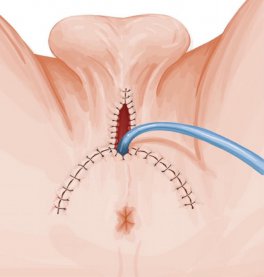Perineal Urethrostomy